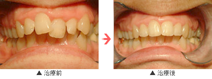 笑顔に自信を持てる矯正治療