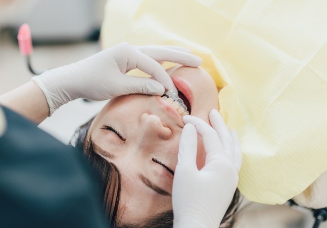 日常生活への制限が少なく、無理なく矯正治療を継続しやすい点も、マウスピース型矯正装置の魅力です。