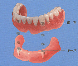磁石式入れ歯を採用しています