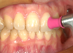 歯を守る習慣、はじめよう