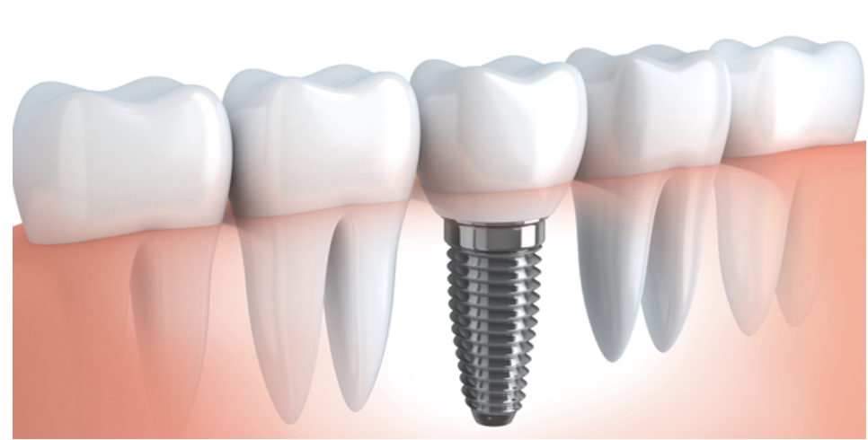 失った歯の機能を回復するためのインプラント治療を行っています