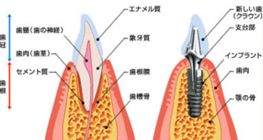 インプラントでしっかり噛める喜びを味わいましょう