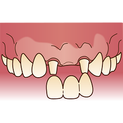 しっかり咬める喜びを取り戻す義歯治療