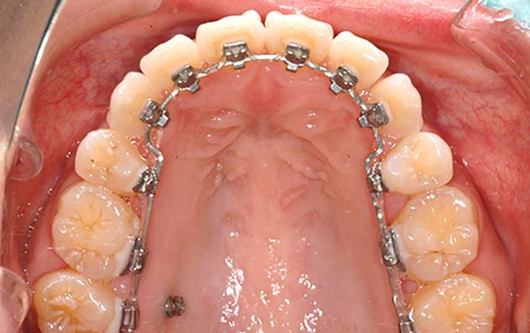 目立たない装置と成長期の特性を活かした最適な矯正アプローチ