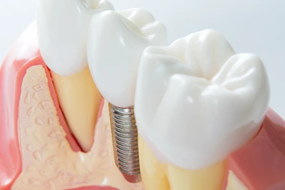 インプラント治療-違和感なく使える理由とは？