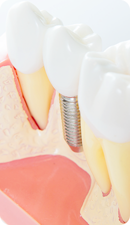 見た目も自然なインプラント