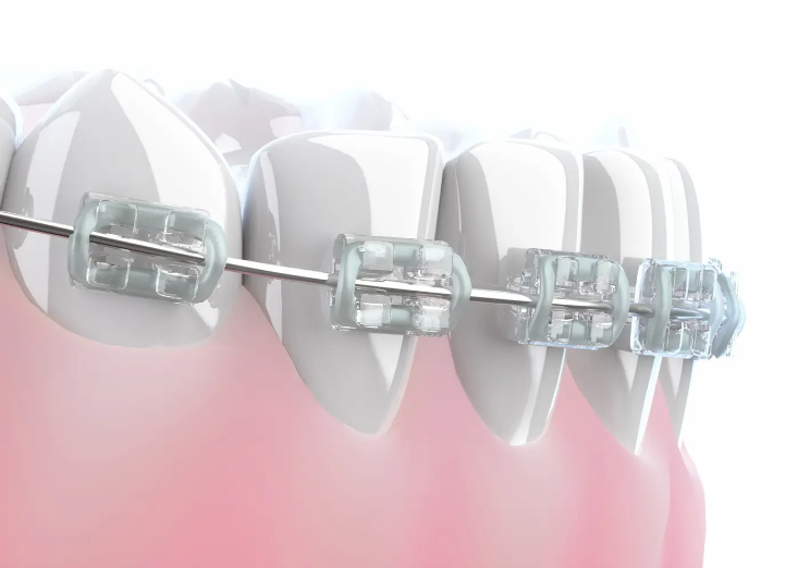 初回の矯正相談は無料です