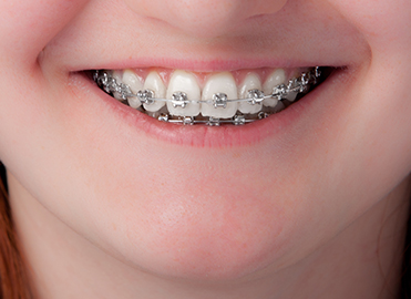 矯正は大人になってからでも遅くありません