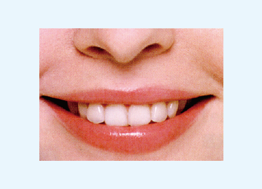 う蝕治療と審美治療を組み合わせた治療法を提供いたします