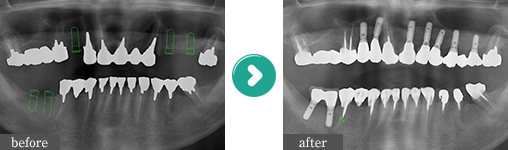 失った歯を自然に美しく回復新しい治療法