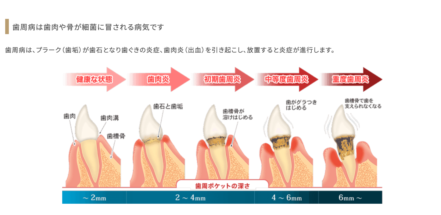歯を支える歯茎や骨の健康を守るための歯周病治療を提供しています