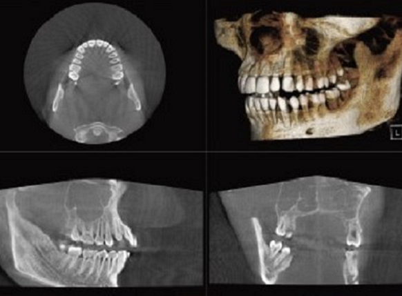 歯科用CTによる3D画像を治療に活用します