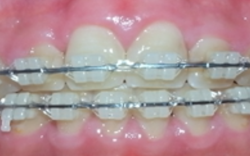 幼児期からのムーシールドで受け口を改善、将来の矯正負担を軽減