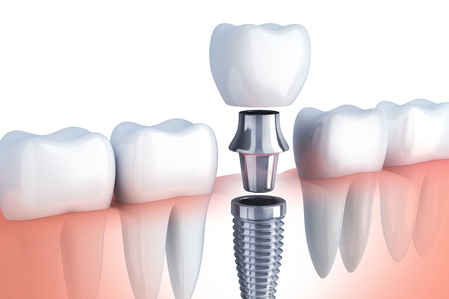 歯科用CTを用いた精密な検査から計画を立てます
