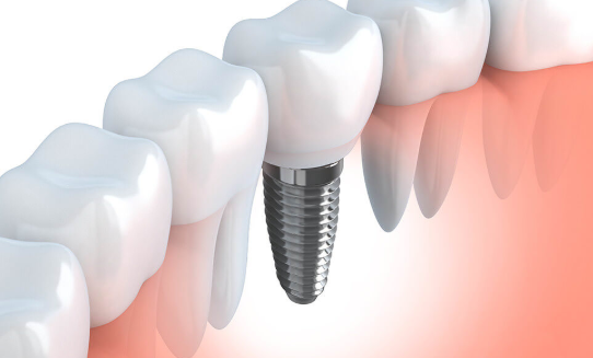 インプラント治療は榎本歯科医院へお任せ下さい