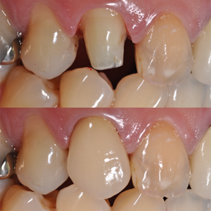 セラミックを使うことでより自然な色を表現できます