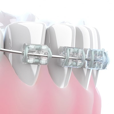 歯並びを良くして健康に