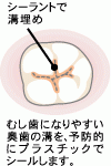 「シーラント」は奥歯のかみ合う面（咬合面）にできる虫歯の予防の方法