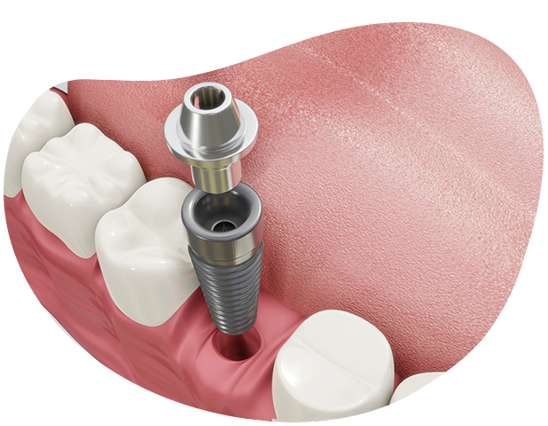 インプラントの仕組み