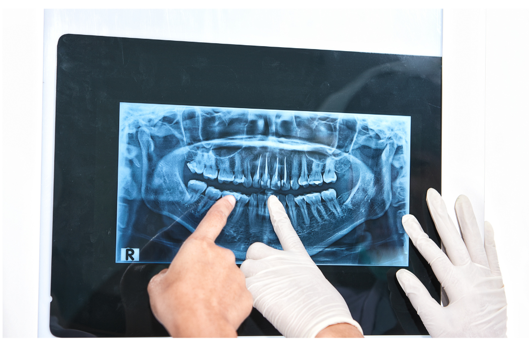 むし歯治療において患者様の不安を最優先に考えています