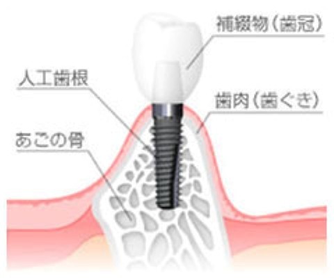 天然歯に近い感覚で食事ができ、会話や笑顔の際にも口元を気にせず過ごせる点が大きな魅力です。