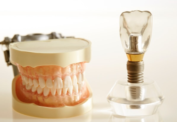 しっかり噛める歯を、長く保つインプラント治療