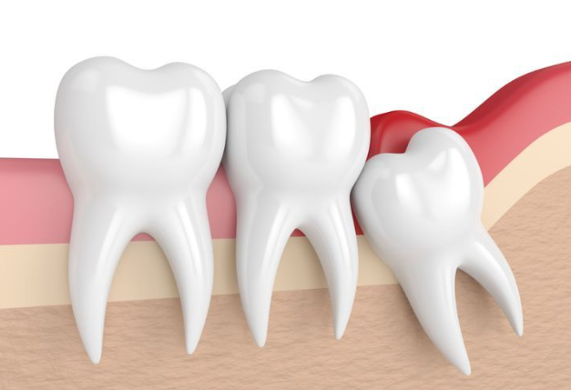 親知らずの抜歯もしています