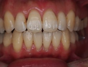 マウスピース矯正