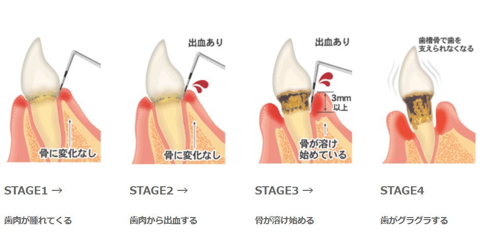 歯周病の進行イメージ