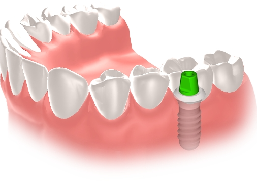 インプラント治療