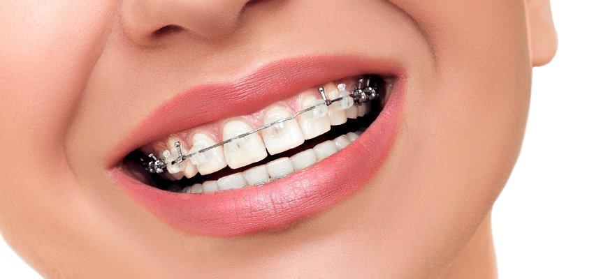 見た目のコンプレックス改善や虫歯・歯周病予防につながる治療方法です。