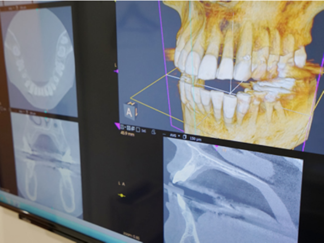 安全性に十分配慮したインプラント治療