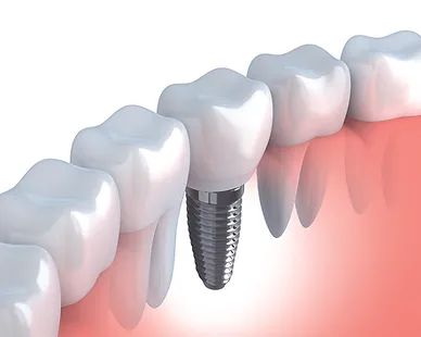 インプラント治療のこだわりポイント