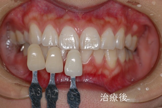 治療後の症例