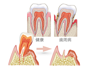 歯周病