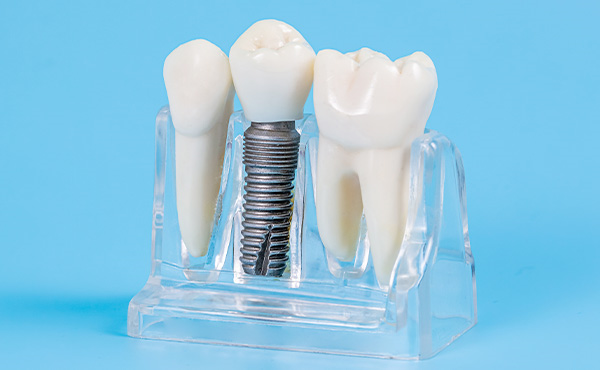 インプラント治療