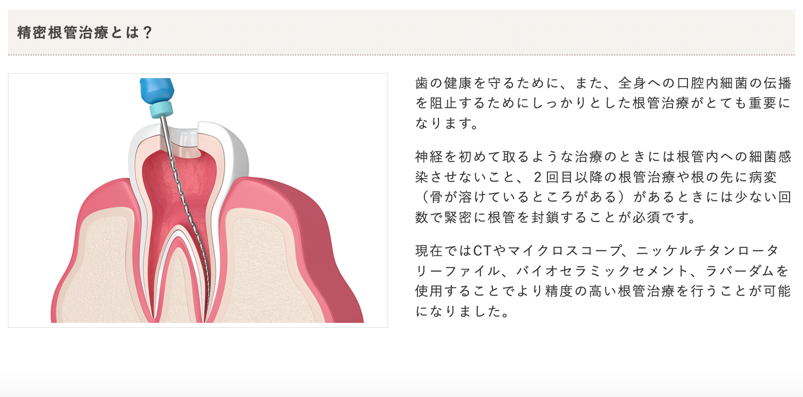 根管治療は、歯の神経部分に生じる炎症や感染に対処し、歯の寿命を保つために不可欠な治療です