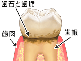 歯周病の早期発見と再発防止を目的とした治療と予防管理を重視しています