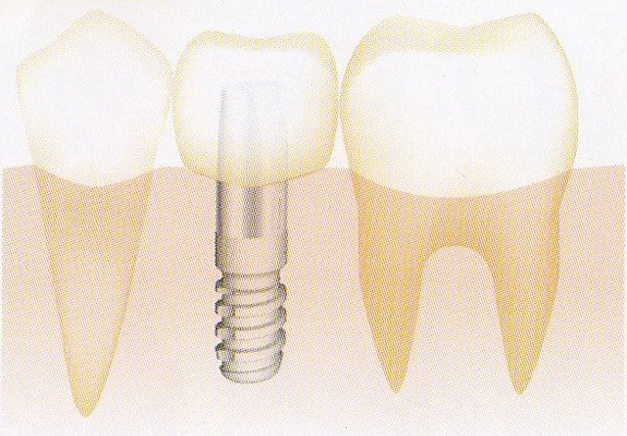 自然な見た目と噛み心地にこだわったインプラント治療を提供