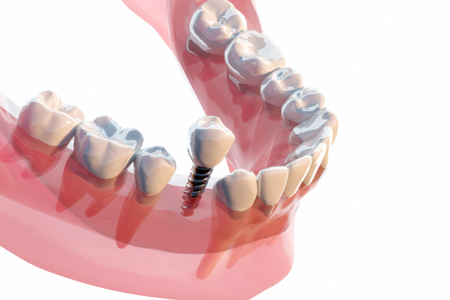 インプラント治療