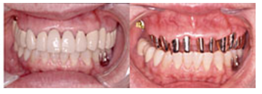 重度歯周病にも対応しています