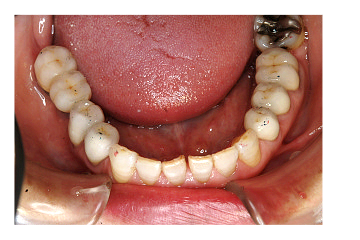 天然の歯のような快適さを実現