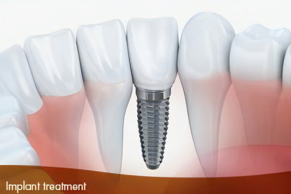 専門医によるインプラント治療を提供