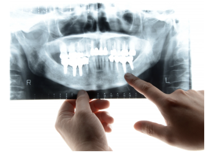 マイクロスコープやラバーダムを活用し、精密かつ安全な治療環境を整えています