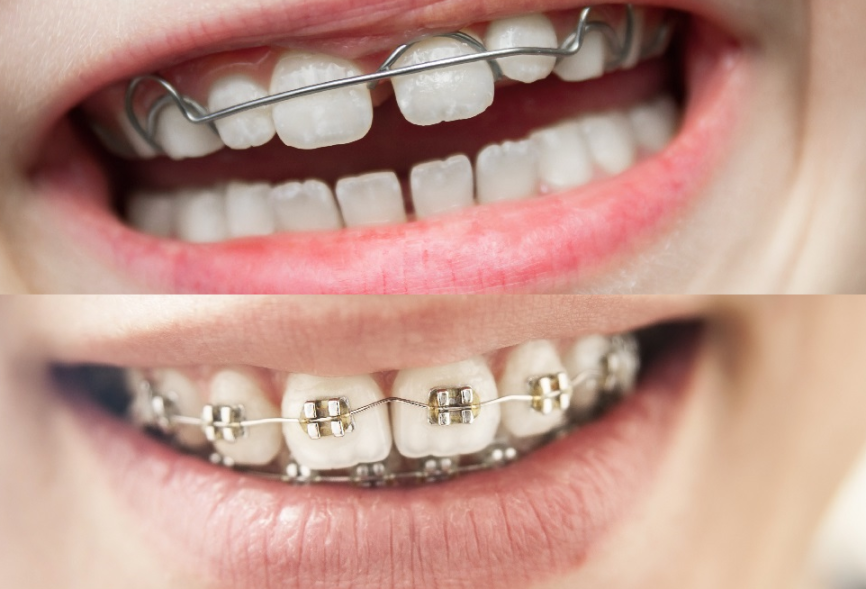 ワイヤー矯正やマウスピースの矯正などがあります