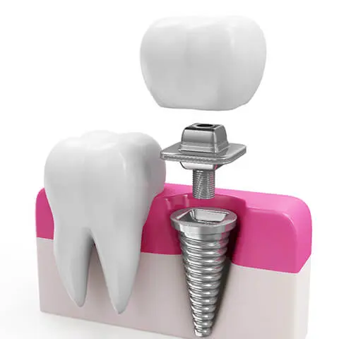 患者様の生活の質向上に貢献できるインプラント治療を実施しています