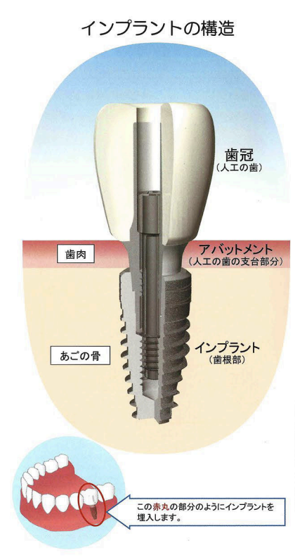 歯を失った際に考えられるさまざまな治療法を提供しています