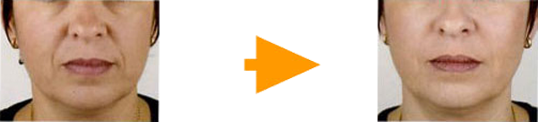 約半年から1年効果が続く持続力も魅力です