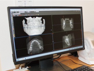 歯科用CTを活用した精密な診査・診断のもとでインプラント治療に対応しています。※写真はイメージです。