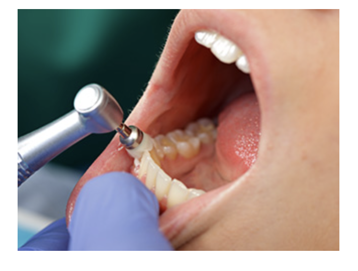 痛みや違和感がなくても、定期的な検診を受けることで虫歯を未然に防ぐことができます